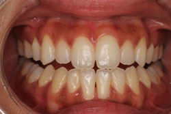 ホワイトニング