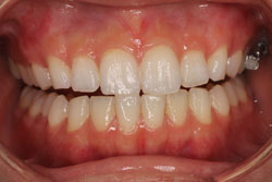 ホワイトニング