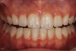 ホワイトニング