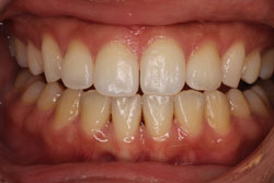 ホワイトニング