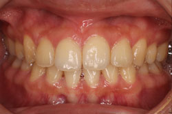 ホワイトニング