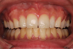 ホワイトニング