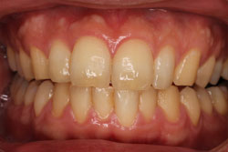 ホワイトニング